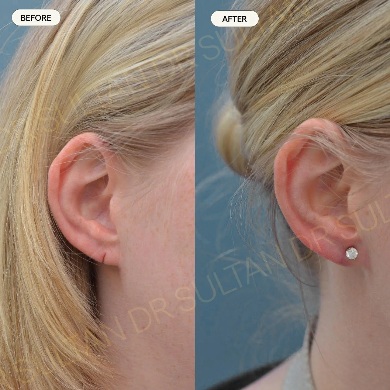 Before and after image published in Dr Sultan's ear gallery.