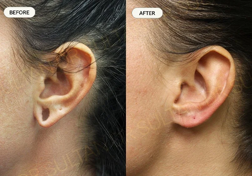 Before and after image published in Dr Sultan's ear gallery.