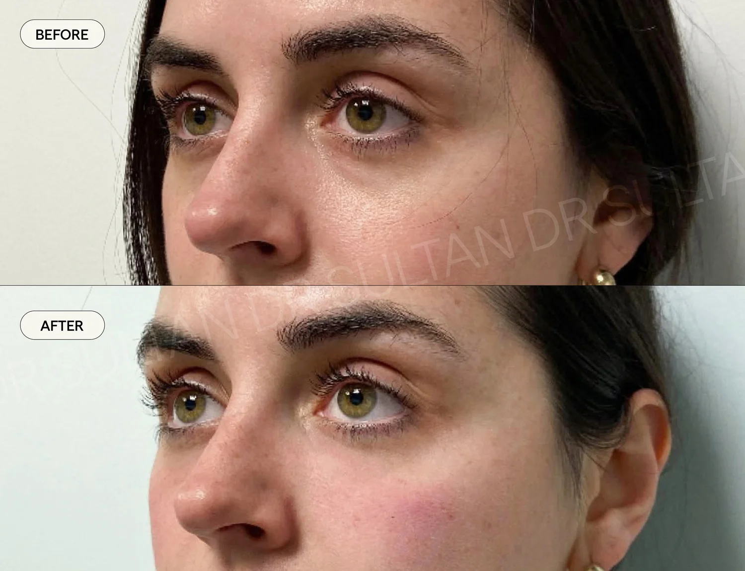 Before and after image published in Dr Sultan's face and eyes gallery.