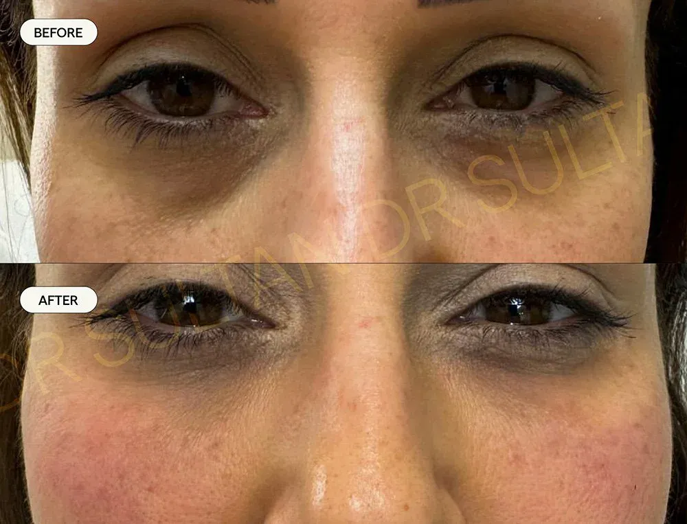 Before and after image published in Dr Sultan's face and eyes gallery.