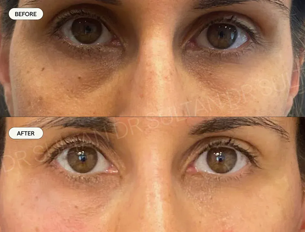 Before and after image published in Dr Sultan's face and eyes gallery.