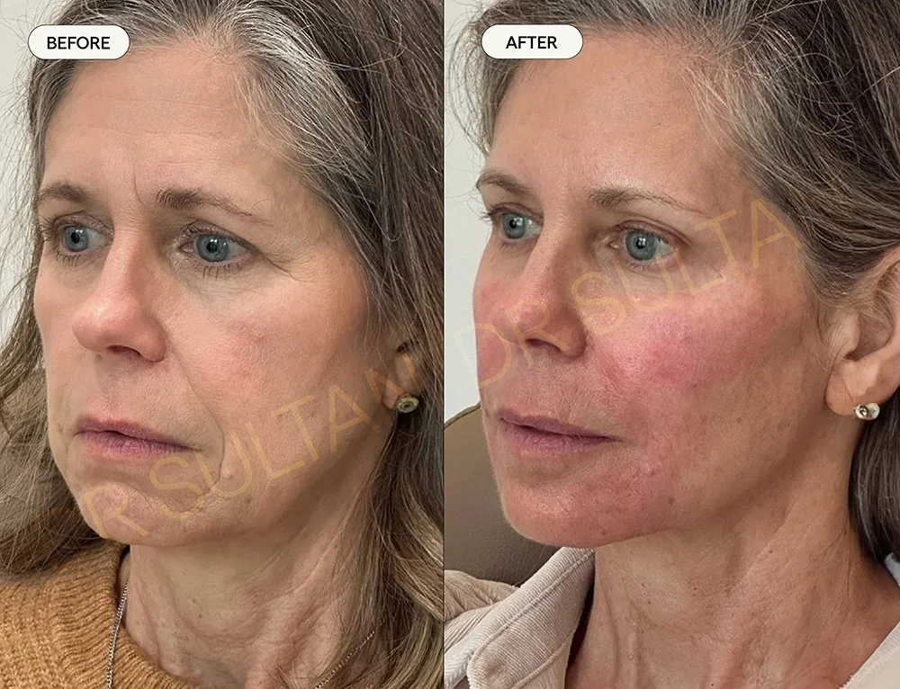 Before and after image published in Dr Sultan's face and eyes gallery.