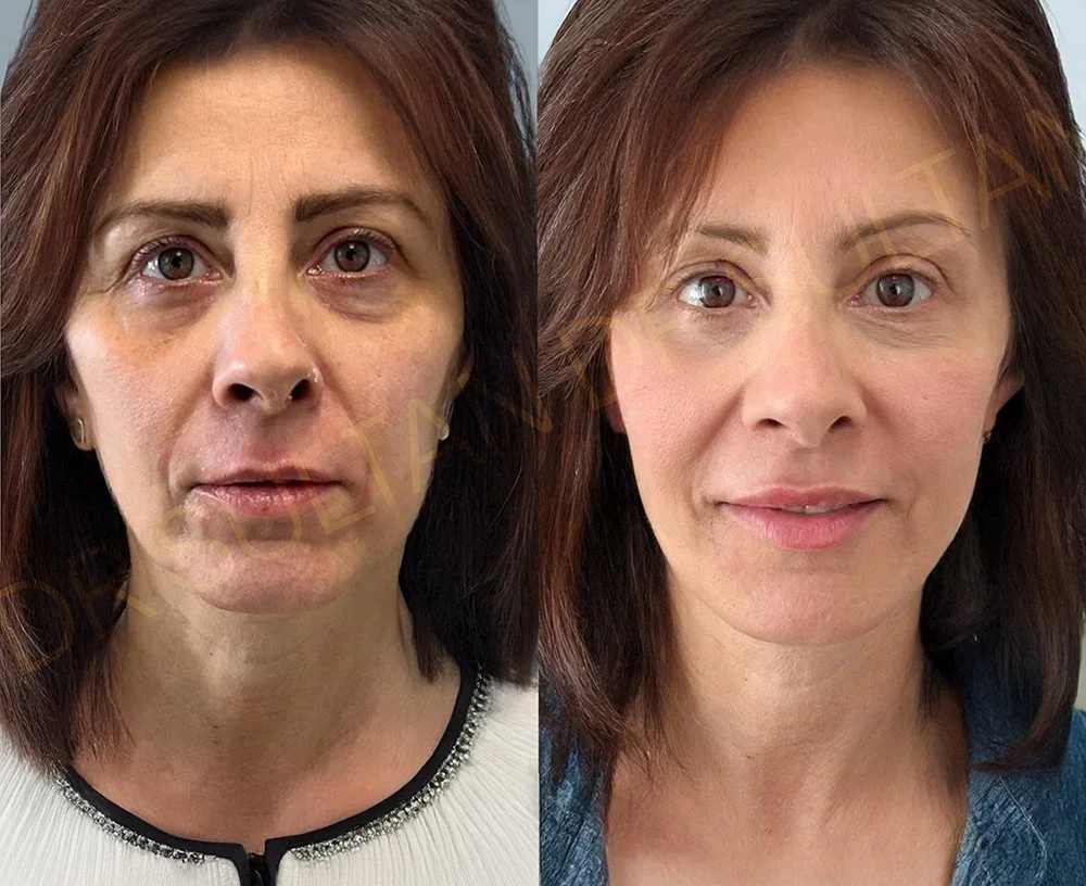 Before and after image published in Dr Sultan's face and eyes gallery.