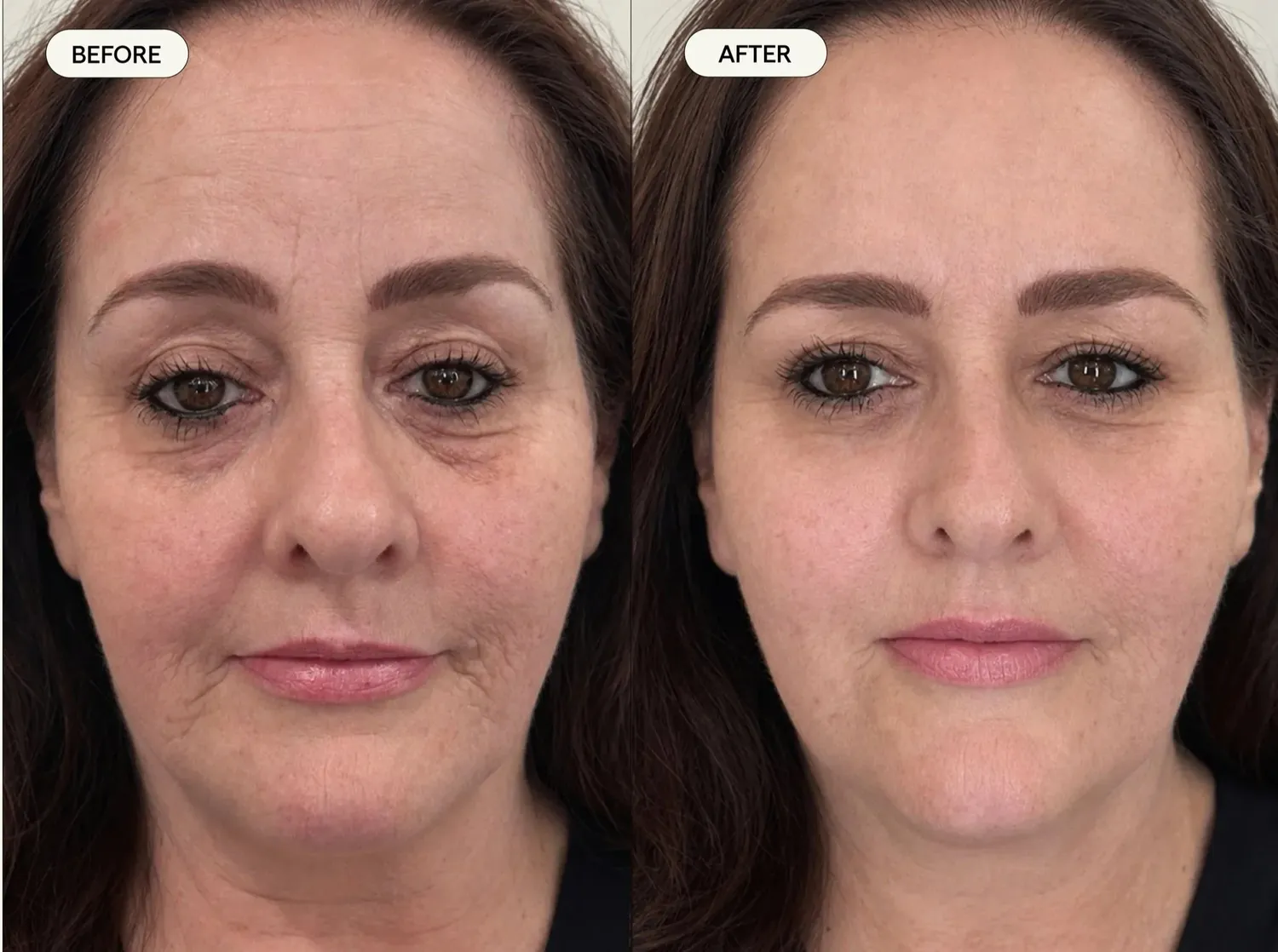 Before and after image published in Dr Sultan's face and eyes gallery.
