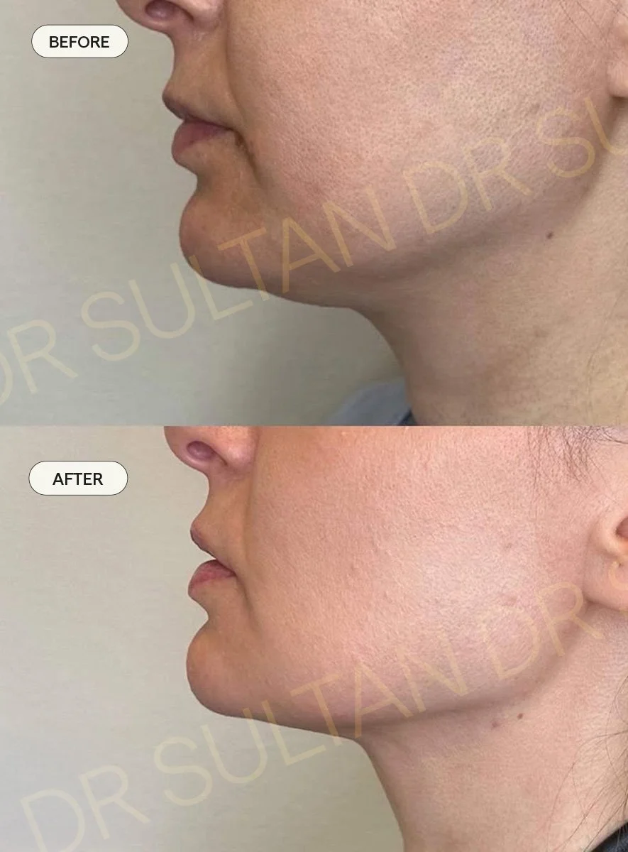Before and after image published in Dr Sultan's FaceTite gallery.