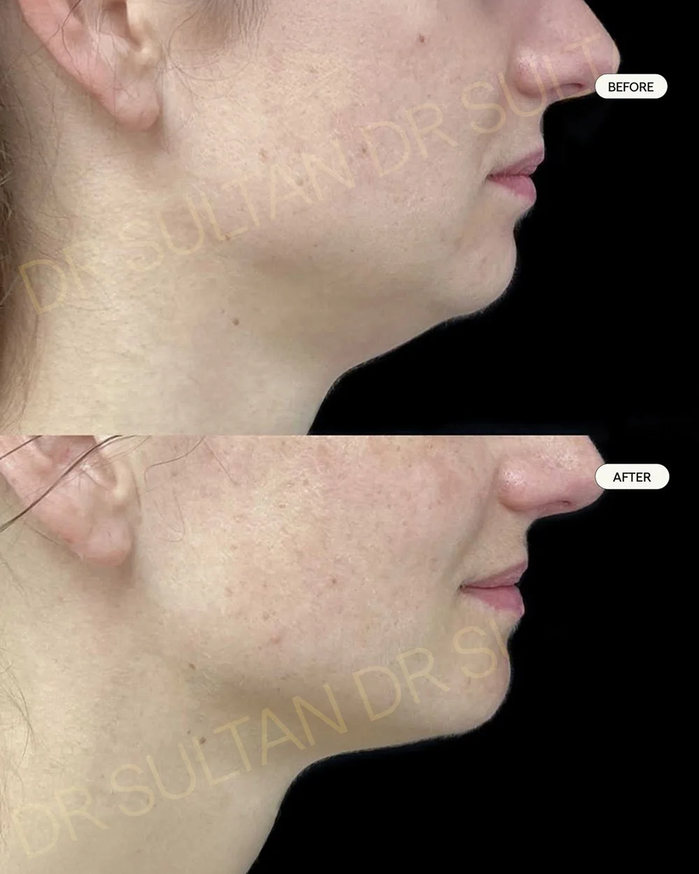 Before and after image published in Dr Sultan's FaceTite gallery.