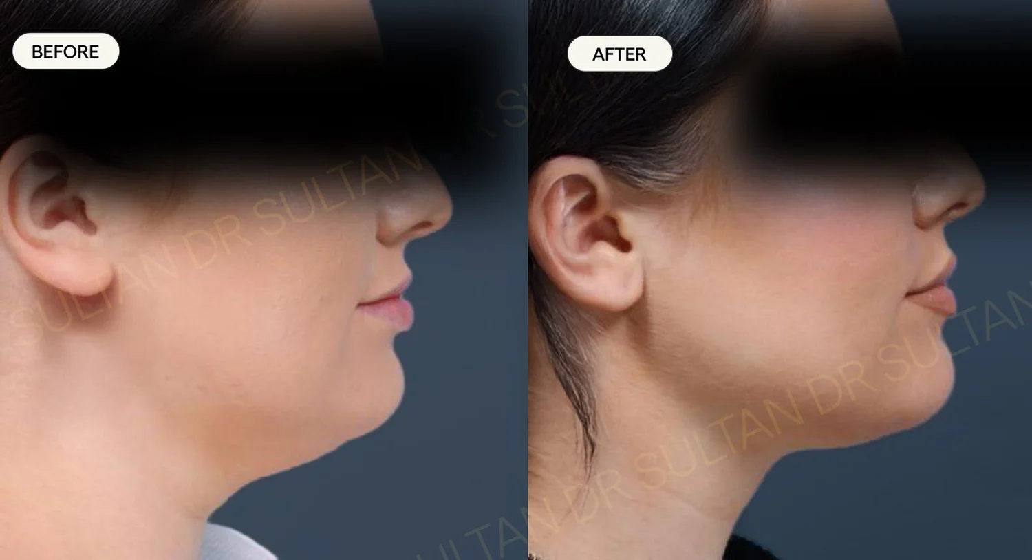 Before and after image published in Dr Sultan's FaceTite gallery.