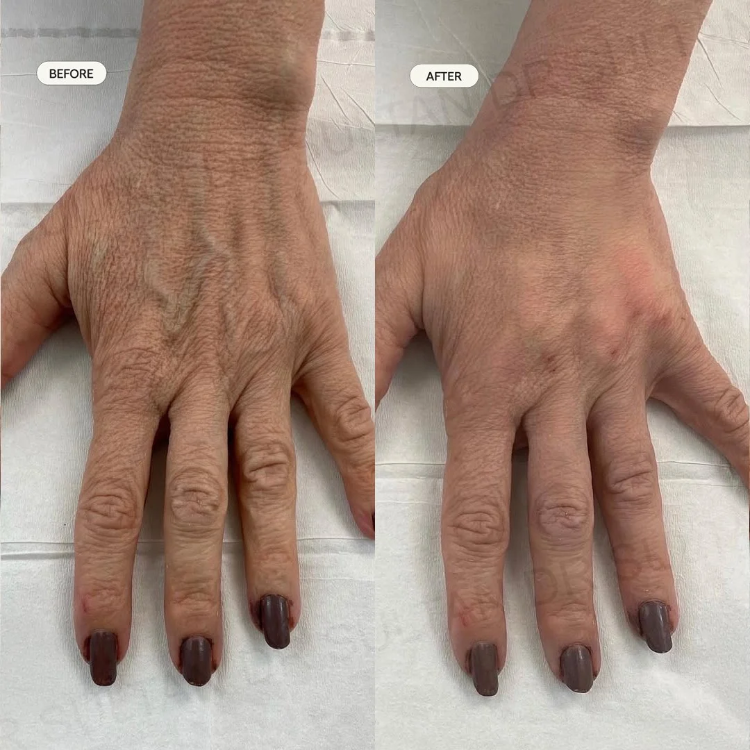 Before and after image published in Dr Sultan's hands gallery.