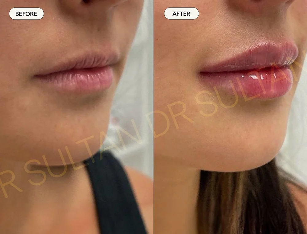 Before and after image published in Dr Sultan's lips gallery.