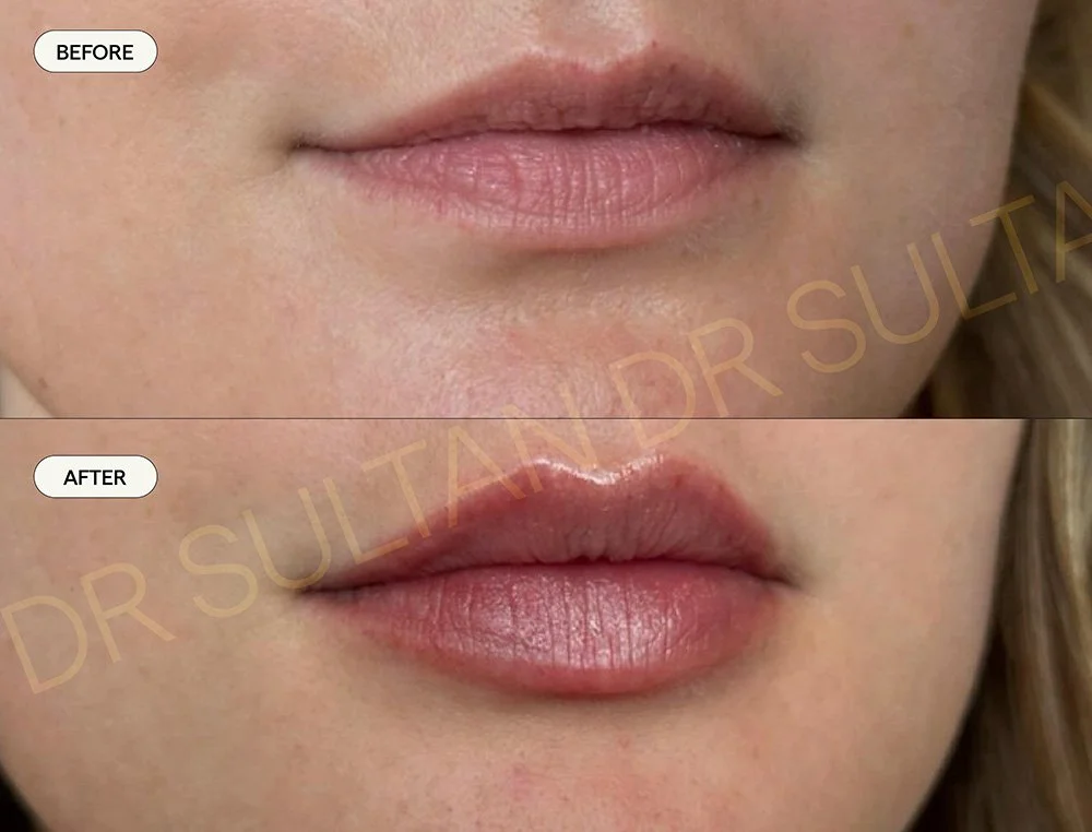 Before and after image published in Dr Sultan's lips gallery.