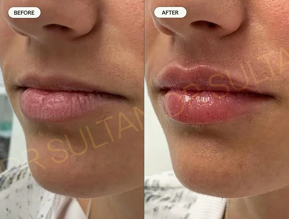 Before and after image published in Dr Sultan's lips gallery.