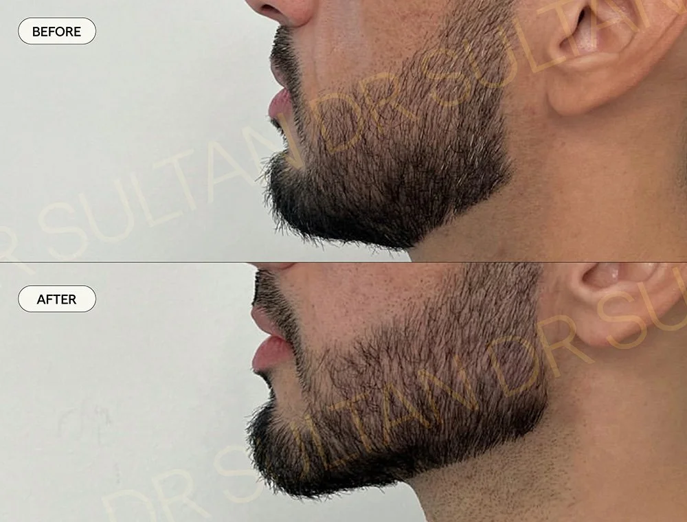 Before and after image published in Dr Sultan's gallery for men.