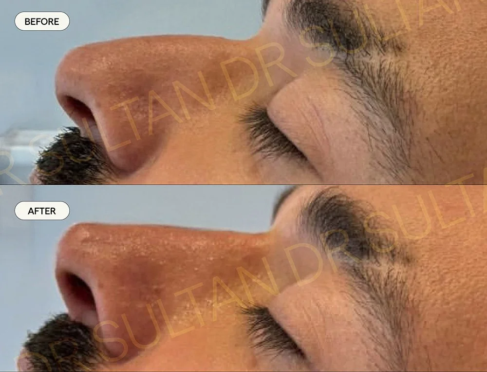 Before and after image published in Dr Sultan's gallery for men.