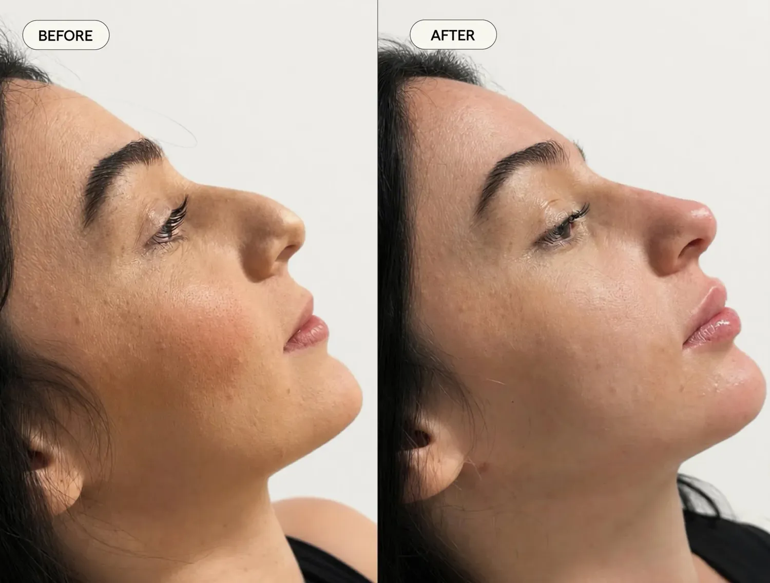 Before and after profile image published in Dr Sultan's face and eyes gallery.