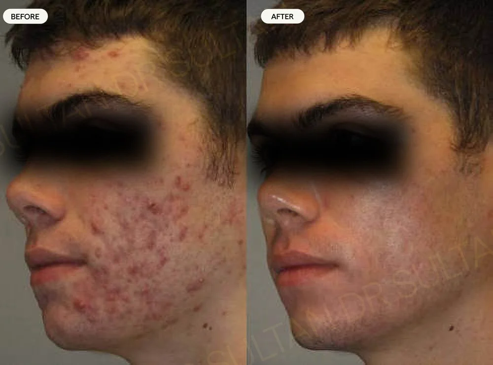 Before and after image published in Dr Sultan's scars gallery.