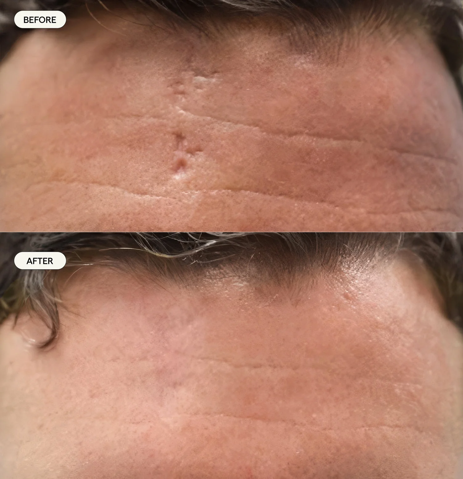 Before and after image published in Dr Sultan's scars gallery.