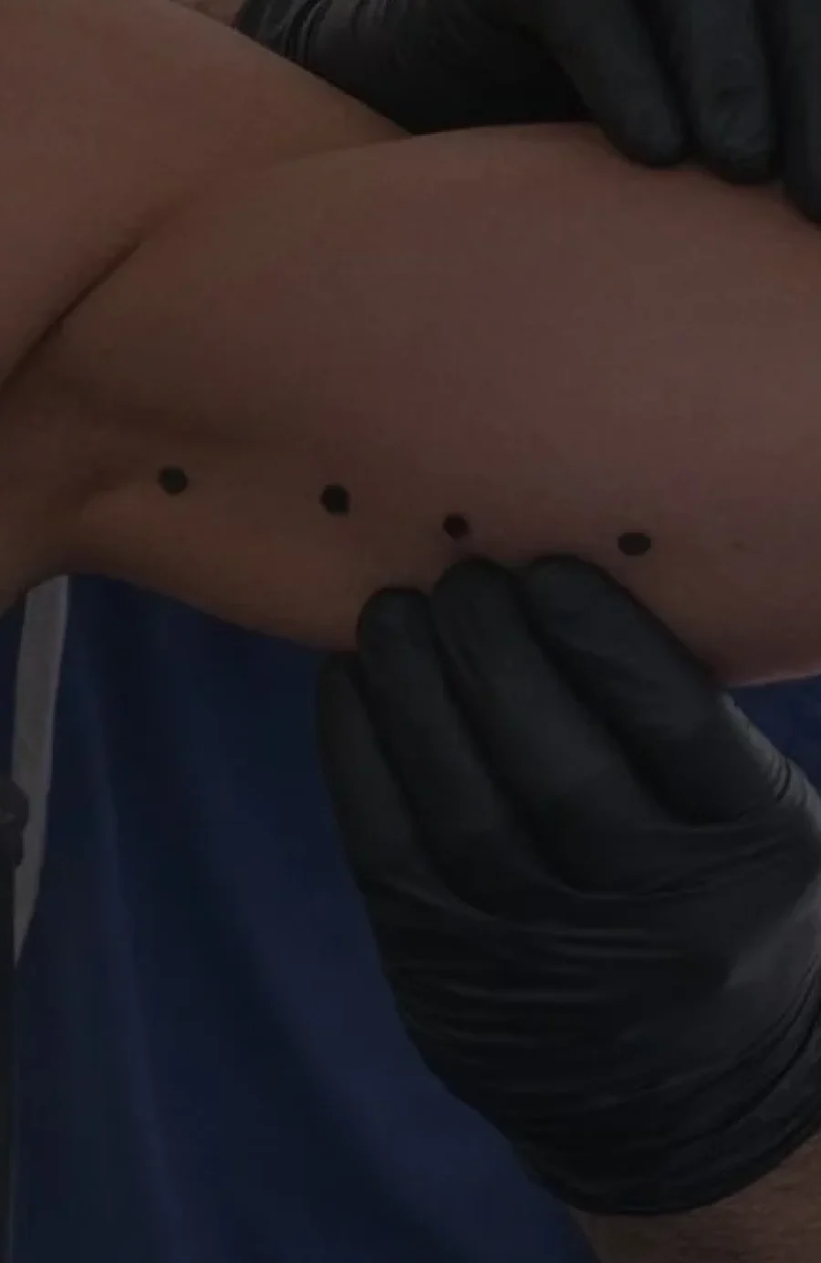 scar revision being carried out at Dr Sultan's clinic on Hollywood Road, Chelsea