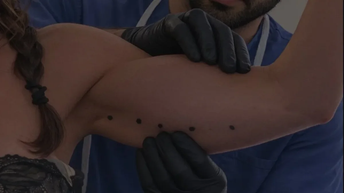 Keloid scars at Dr Sultan's Chelsea clinic