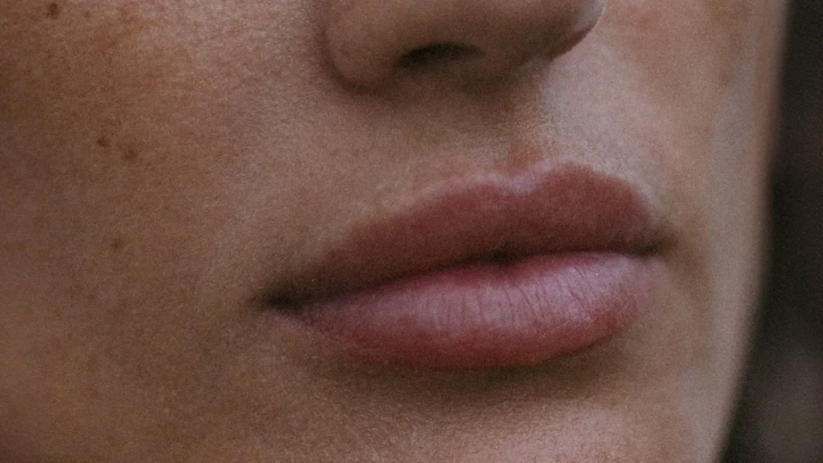 Thin or lined lips treatment at Dr Sultan's Chelsea clinic