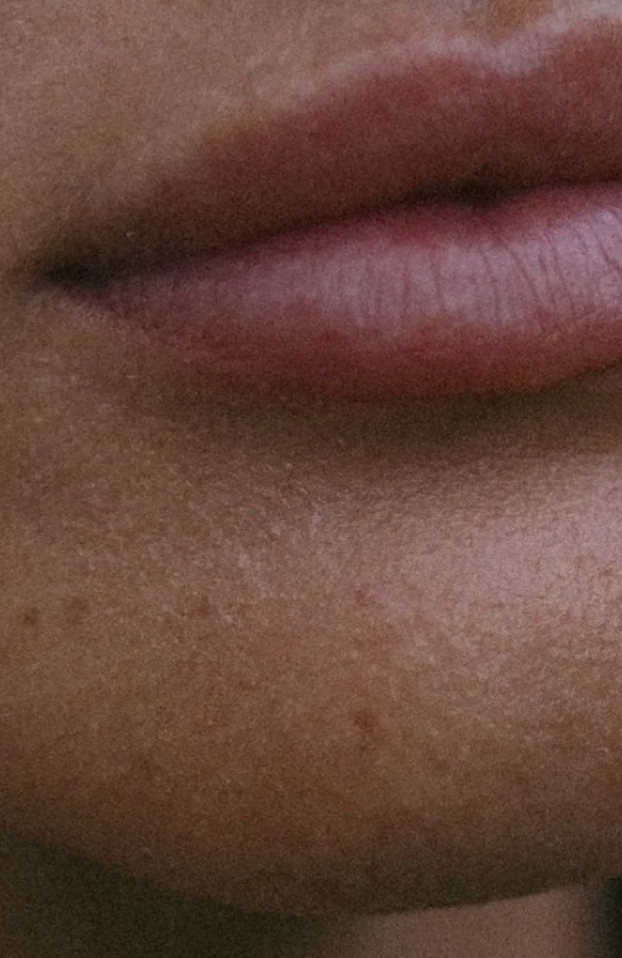 skin boosters being carried out at Dr Sultan's clinic on Hollywood Road, Chelsea